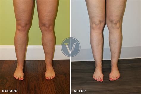 Before And After Nurse Was Treated For Swollen Legs And Heaviness
