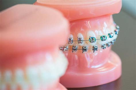 10 Fun And Crazy Facts About Braces And Orthodontics Fergus Orthodontics