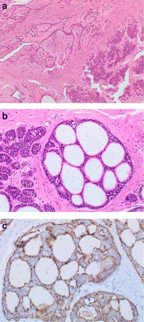 Lcis Involving Benign Lesions A Classical Lcis And Invasive Carcinoma