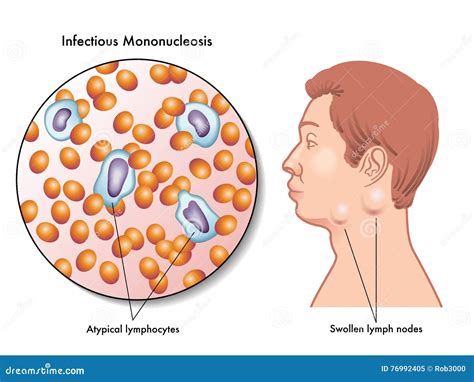 Mononucleosis Stock Vector Illustration Of Swollen Lymph 76992405