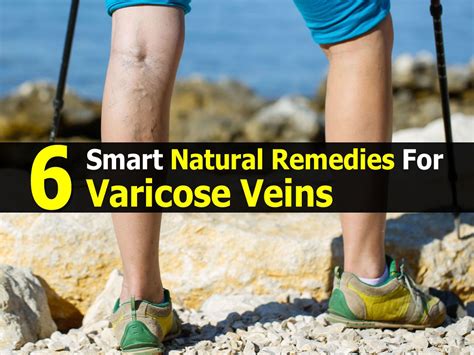 6 Smart Natural Remedies For Varicose Veins