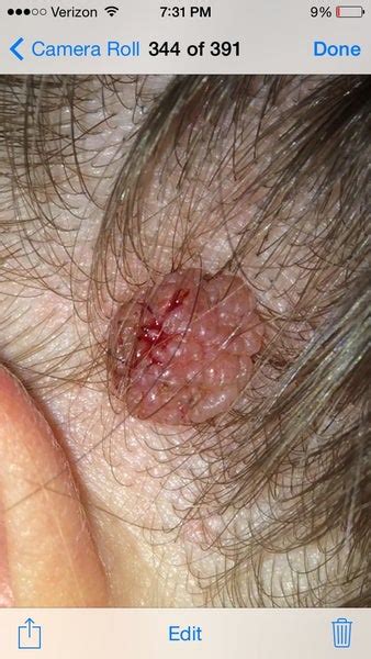 Unfortunately, most moles are considered cosmetic issues and insurance will not usually cover their removal. I have a mole on scalp. What type of mole is this? Is it okay that it bleeds, and will insurance ...