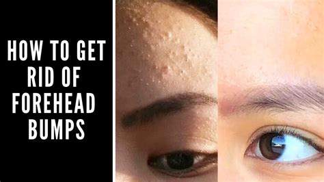 How To Get Rid Of The Bumps On My Forehead