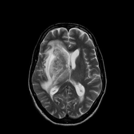 • restriction on diffusion weight mri = more sensitive than conventional sequences. Acute necrotizing toxoplasma encephalitis | Image ...