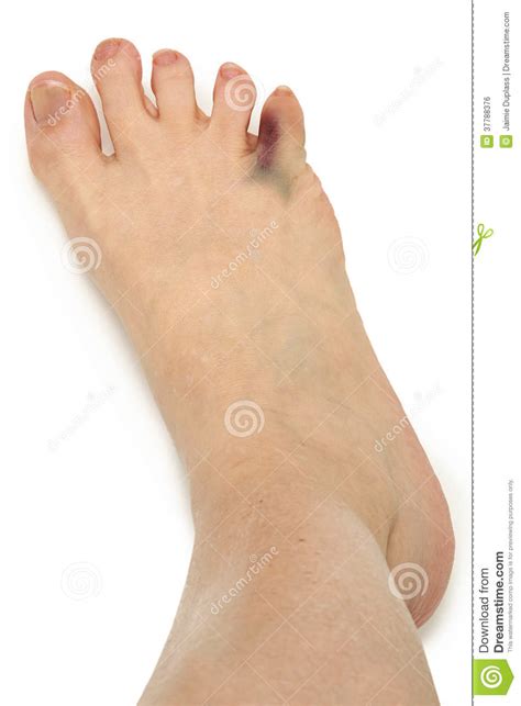 Broken Bruised Toe Over White Stock Photo Image Of Healthcare Feet