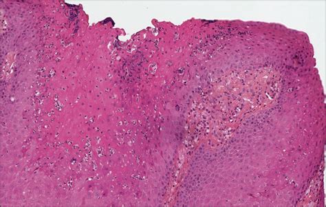 Vulvar Verruciform Xanthoma Ten Cases Associated With Lichen Sclerosus