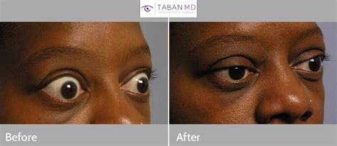 Graves Disease Before And After Gallery Taban Md