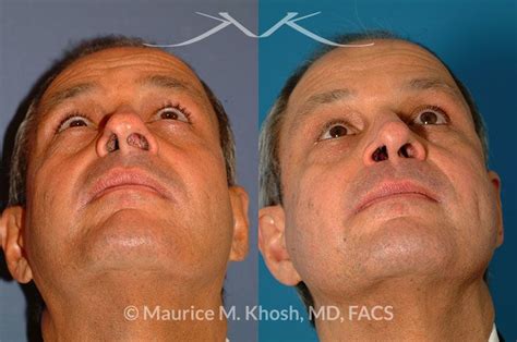10 Nasal Valve Collapse Surgery Before And After Saphireammara