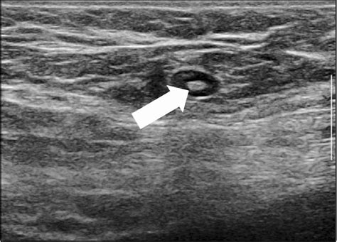 Sonographically Normal Axillary Lymph Node Image In A 75 Year Old Woman