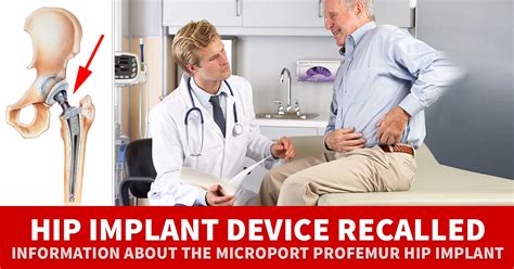 Hip Implant Lawsuits For Microport® Profemur™ Recall