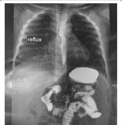 Suspicious Image Of A Diverticulum In The Left Esophageal Wall
