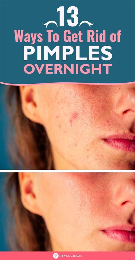 how to get rid of pimples overnight fast how to get rid of pimples pimples how to reduce pimples