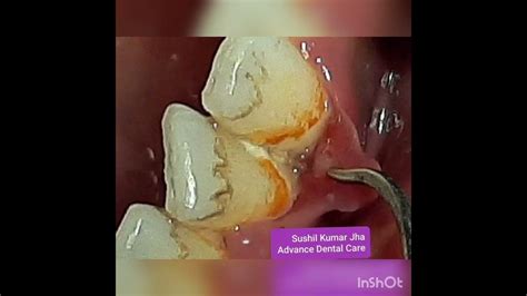 Simple Prophylactic Treatment To A Hyperplastic Gingivitis Case Due To