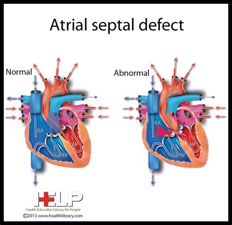Atrial Septal Defect On Pinterest