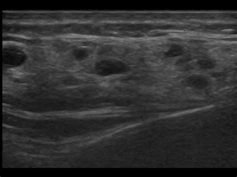 Parotid Gland Parotitis