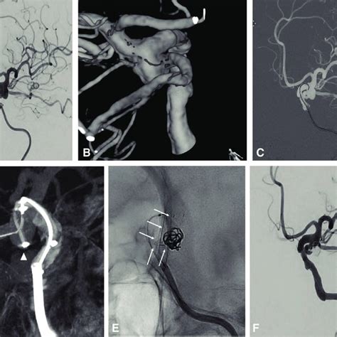 Intraoperative Finding A Left Deep Femoral Artery Aneurysm Arrow