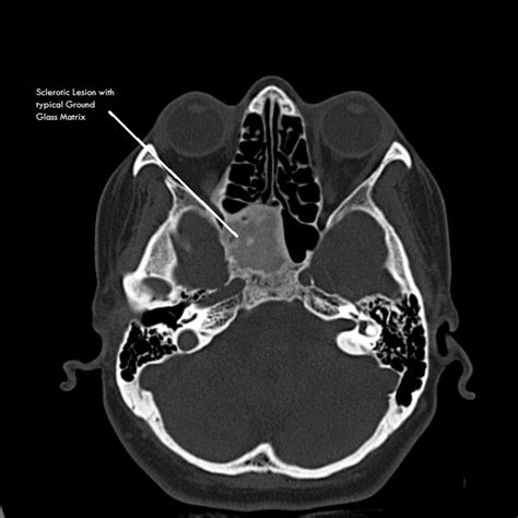 Ultimate Radiology Case Of The Day Sclerotic Sphenoid Lesion