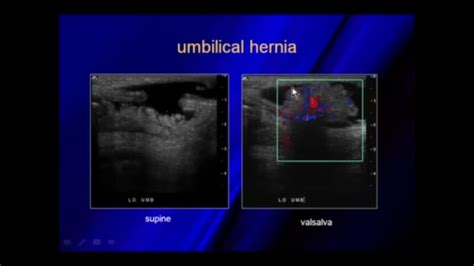 Ultrasound Of Hernias Ultrasound Sonography Medical Images And Photos Finder