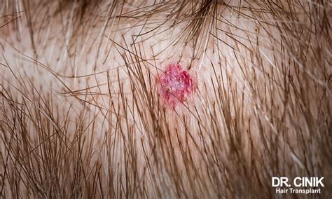 scabs and soreness on the scalp 11 1 reasons