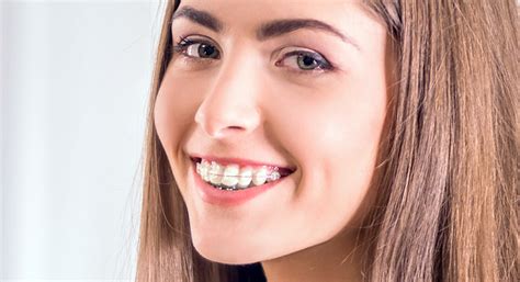 Clear Braces In Crown Point Puntillo Crane Orthodontics