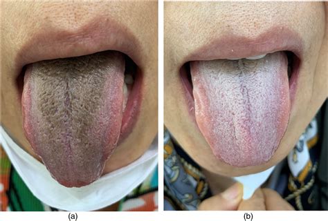 Linezolid Induced Black Hairy Tongue In A Patient With Multidrug