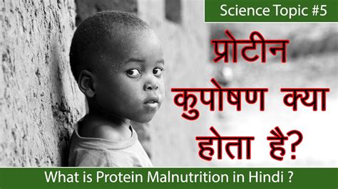 Protein Kuposhan Kise Kahate Hain What Is Protein Malnutrition