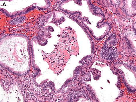 Atypical Endometrial Hyperplasia And Well Differentiated Endometrioid Adenocarcinoma Of The