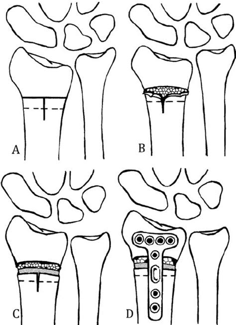 Schematic Outline Of The Corrective Osteotomy Of The Radial Bone With
