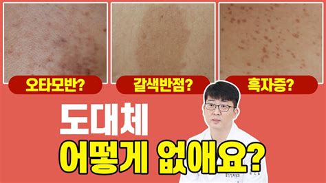 피부 갈색 반점 오타모반갈색반점흑자증 치료방법 파헤치기 👨‍⚕‍피부과전문의추천 모반 레이저는 최근 답변 66개