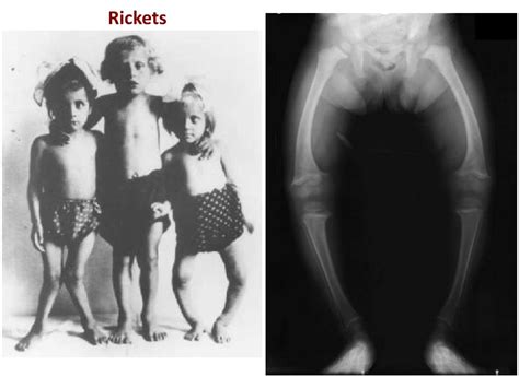 Ppt Drugs Used For Treatment Of Osteoporosis And Rickets