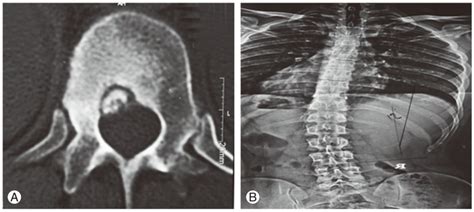 A Involvement Of Body Of T12 Vertebra With Painful Scoliosis In An