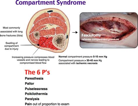 Ps Of Compartment Syndrome