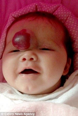 Maybe you would like to learn more about one of these? Toddler has tomato-sized birthmark successfully removed ...