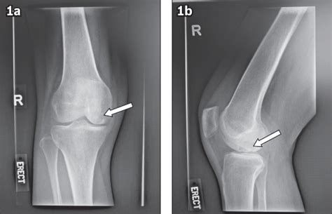 Knee Subchondroplasty For Management Of Subchondral Bone Cysts A Novel