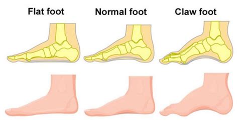 Flat Feet Orchard Health Clinic Osteopathy Physiotherapy And