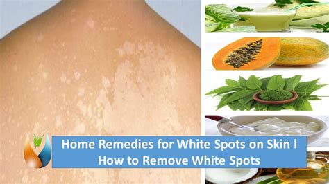 Medicine For White Spots On Skin News And Health