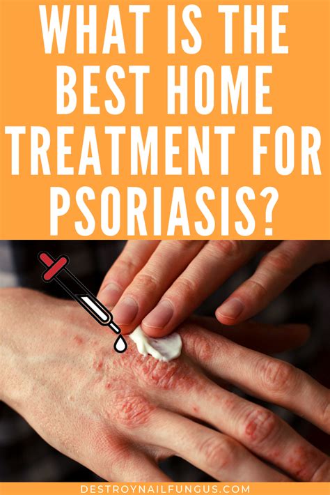 5 Amazing Home Remedies For Psoriasis That You Need To Try Now