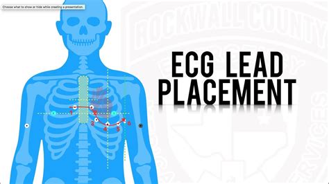 Super Simple Ecg Sticker Placement Youtube