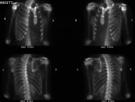 Bilateral First Rib Stress Fractures In A Female Swimmer A Case Report