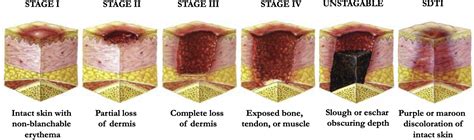 Verdict For Infected Pressure Injury Poliakoff And Associates Pa