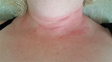 Neck And Exposed Chest Eczema