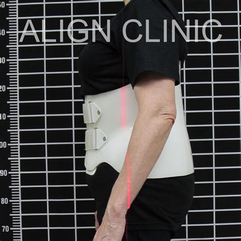 Adult Scoliosis Bracing Align Clinic