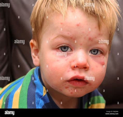 sintético 93 foto imagenes de varicela en niños vacunados actualizar