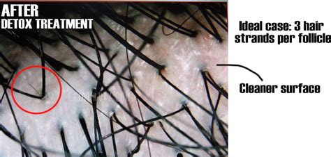 While there may be other contributing factors, the main reason clogged hair follicles leads to hair loss is follicle miniaturization. Hair Loss Treatment - Detox Treatment @ Phyto Hair Science ...