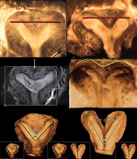 Bicornuate Uterus Ultrasound