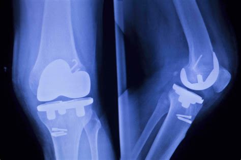 Knee Joint Implant Replacement Xray Showing In Medical Orthpodedic