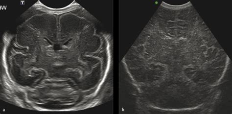 Neonatal Cranial Sonography Ultrasound Findings In Ne