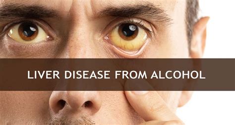 Alcoholic Liver Disease Symptoms Stages And Treatment Options