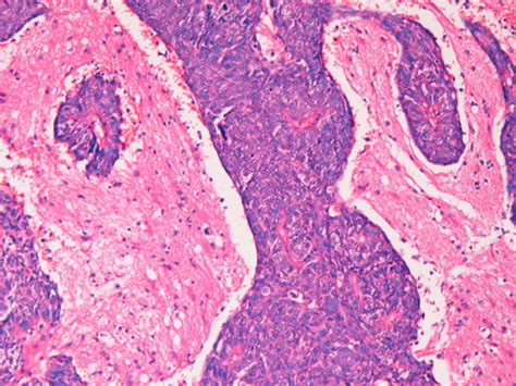 Histology Of The Brain Tumor Undifferentiated Carcinomatous Tissue Is