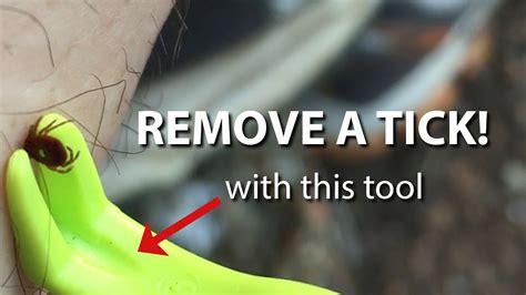 Remove Ticks Easy With A Removal Tool While Lowering The Chances Of